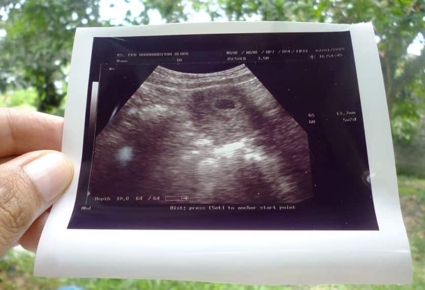 الجنين في ثامن أسبوع من الحمل