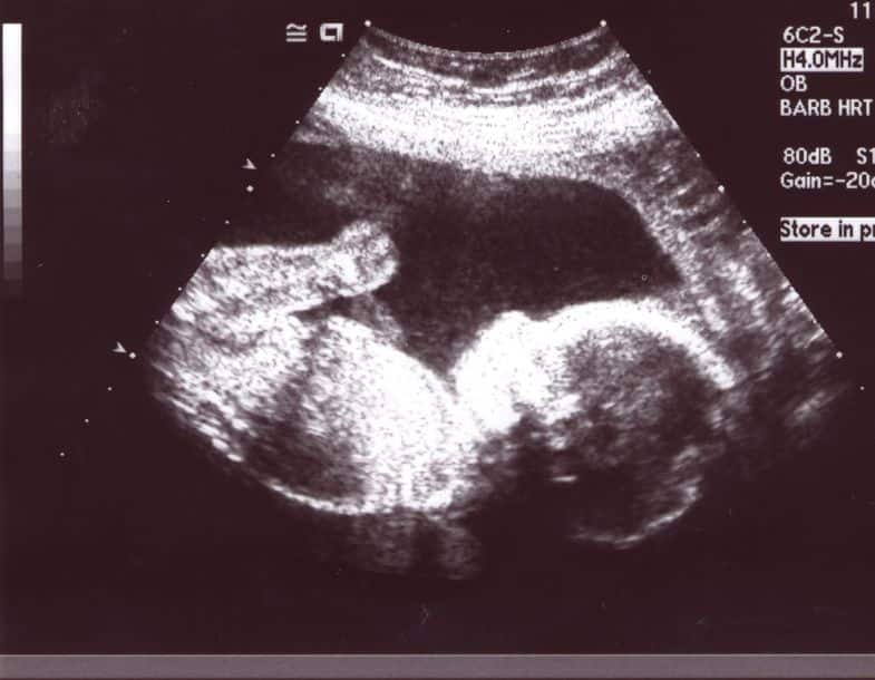 الجنين في رابع عشر أسبوع من الحمل