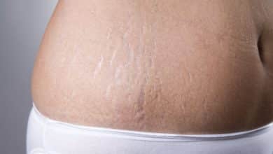 Photo of علامات تمدد الجلد بعد الولادة : أسبابها وطرق التخلص منها بفعالية