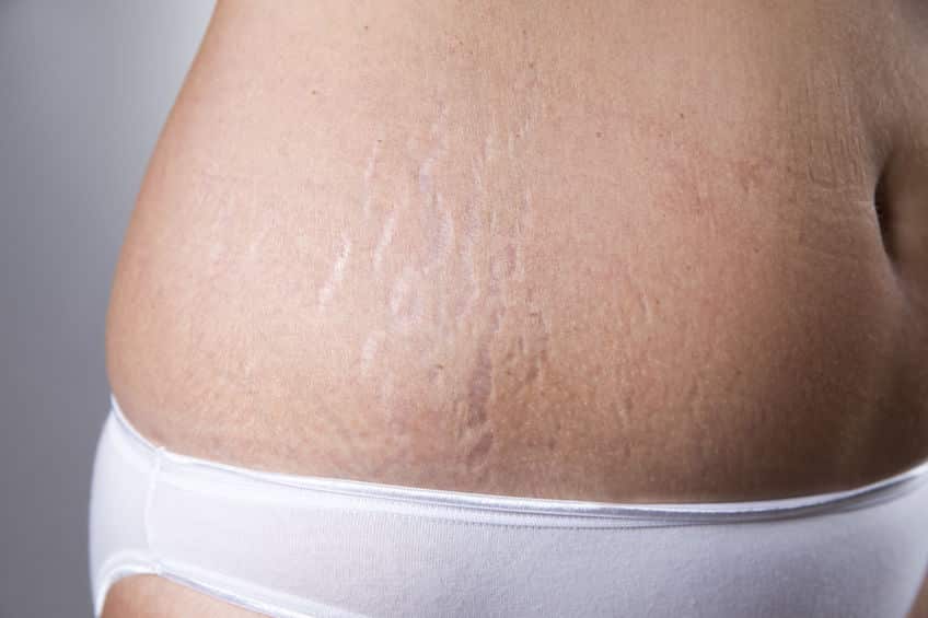 علامات تمدد الجلد بعد الولادة