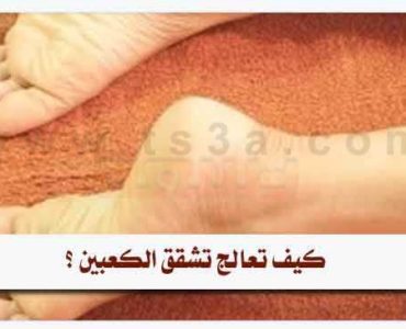كيف تعالج تشقق الكعبين