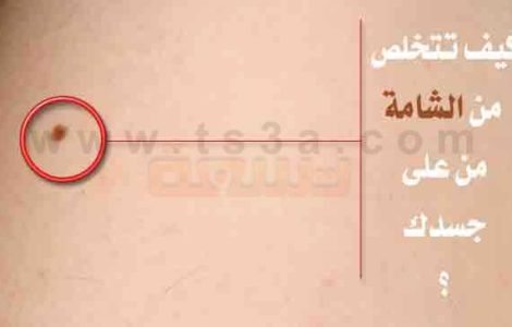 طرق ازالة الشامة كيف تتخلص من الشامة من على جسدك