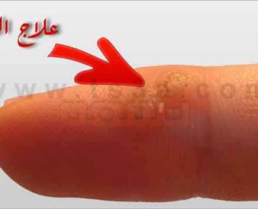 علاج الثآليل ازالة الثآلول