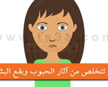 خطوات التحلص من آثار الحبوب و بقع البشرة