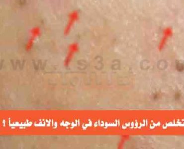 كيف تتخلص من الرؤوس السوداء في الوجه والانف
