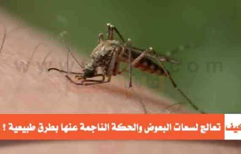 كيف تعالج لسعات البعوض والحكة طبيعيا