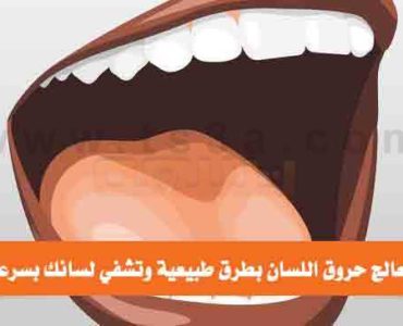 كيف تعالج حروق اللسان بطرق طبيعية
