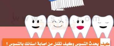 كيف يحدث التسوس وكيف تقلل من اصابة اسنانك بالتسوس