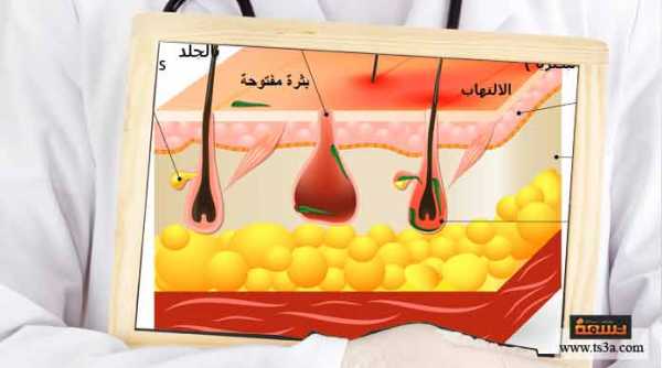 أنواع حب الشباب