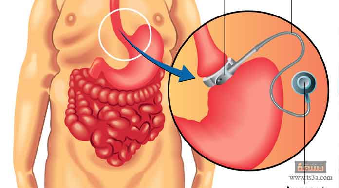 عملية ربط المعدة