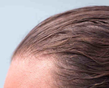زراعة الشعر