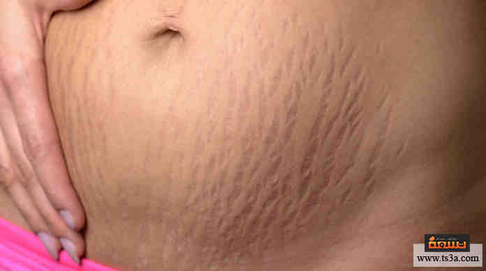 تشققات الجلد أثناء الحمل
