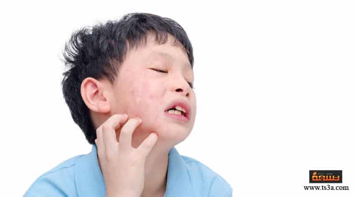 كيف تتعرف على أعراض الغدة النكافية للأطفال وما هي مضاعفاته تسعة