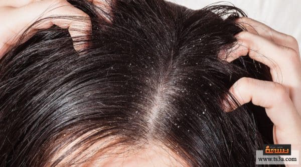 كيف يمكن علاج قشرة الشعر الدهني عند الرجال بسهولة؟ • تسعة