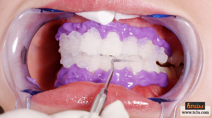 تبييض الأسنان بالزوم الفرق بين تبييض الأسنان بالزوم والتبييض بالطرق الأخرى