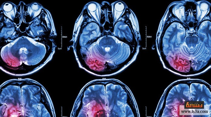 التهاب الدماغ التهاب الدماغ (encephalitis)