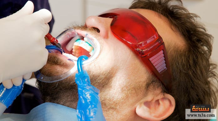 تبييض الأسنان بالأشعة آلية تنفيذ التبييض بالأشعة