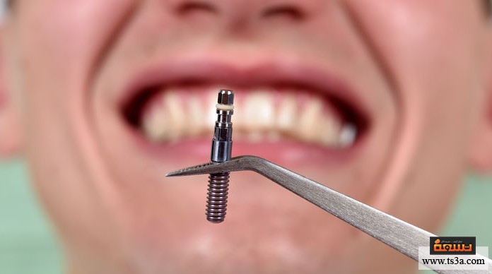 زراعة الأسنان زراعة الأسنان بدون جراحة