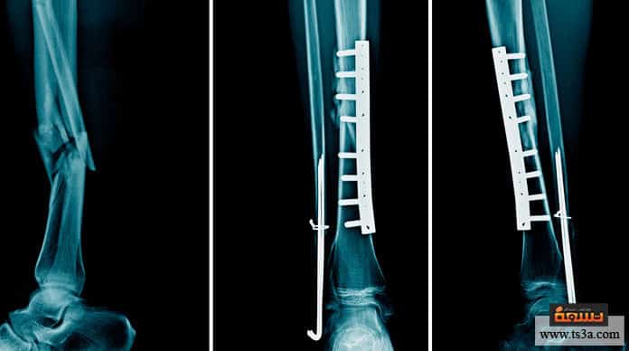 كسر عظمة الشظية علاج كسر عظم الشظية