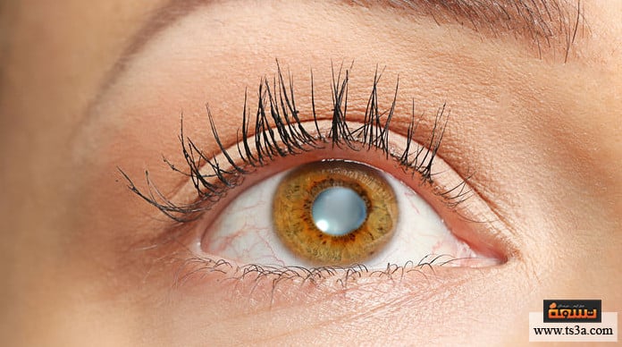 العين الكسولة أعراض العين الكسولة