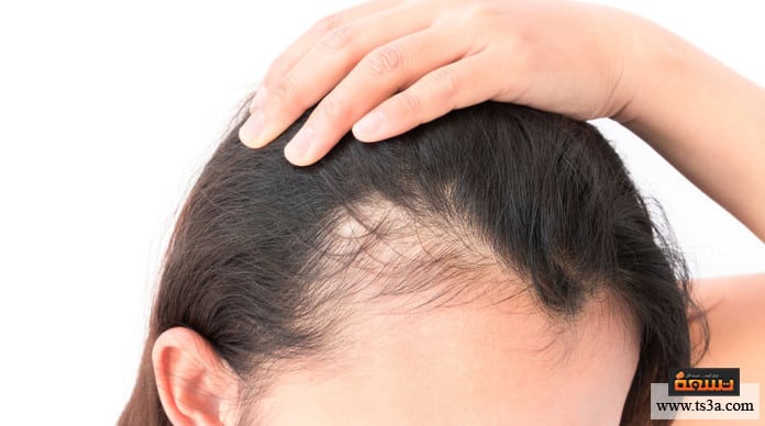 علاج تساقط الشعر بالأعشاب علاج تساقط الشعر الوراثي