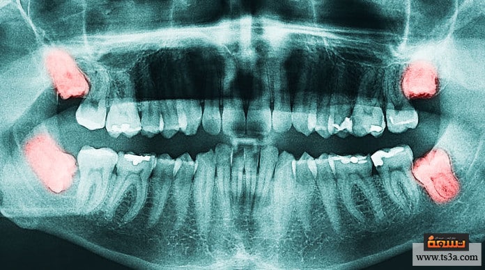 كيف يتم خلع ضرس العقل وهل هناك حاجة لخلعه دون مبرر تسعة