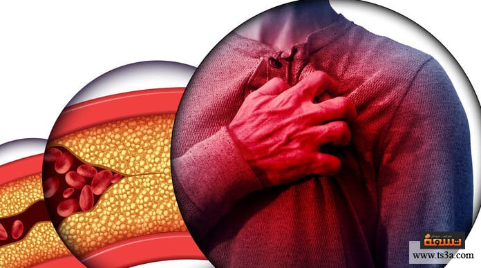 كيف يعالج الطب انسداد الشرايين بالجراحة والطرق البديلة تسعة